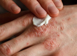 Dermatiti i rëndë atopik mund të shoqërohet me rrezikun e sëmundjeve të zemrës