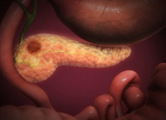 Terapitë e reja zgjasin jetën e pacientëve me kancer pankreatik për pothuajse dy vjet