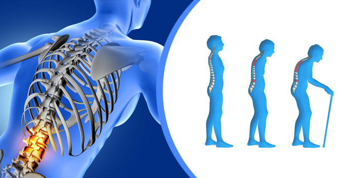 Osteoporosis3
