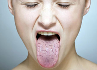 Kur goja e thatë rrezikon shëndetin – xerostomia