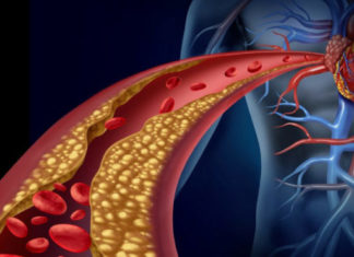 Ateroskleroza – rrezik faktorët, simptomat, trajtimi