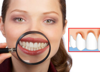 Paradentoza mund të shërohet