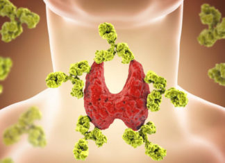 Ënjtja e qafës, lodhja, rënia e flokëve – simptoma të mungesës së jodit