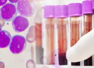 Cilat janë shkaqet dhe kujt i referohet rritja e bilirubinës në gjak?