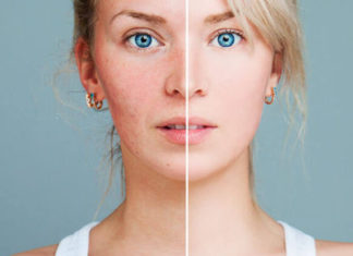 Konsumi i kafesë zvogëlon rrezikun ndaj rozaceas