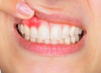Simptomat e inflamacionit të mishit të dhëmbëve (gingiviti)