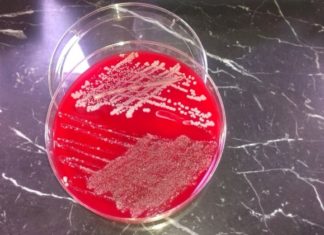 Mbani mend: Këto janë simptomat më të zakonshme të infeksionit me stafilokok