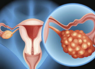 Testi i ri i gjakut zbulon kancerin ovarian në fazë të hershme