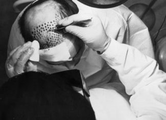 Historia e transplantimit të flokëve