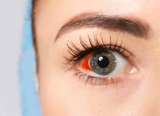 Sa e rrezikshme është pëlcitja e kapilarëve në sy?