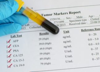 HISTORIA E MJEKËSISË: Kur është zbuluar tumor markeri i parë?