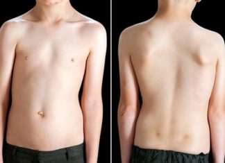 Format më të rënda të skoliozës shfaqen deri në moshën tre vjeçare