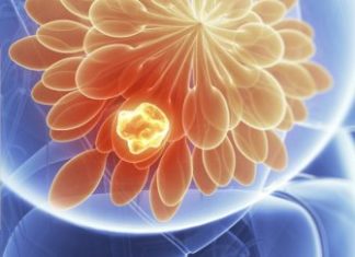 Dr. Nade Petanovska: Biopsia si detektori më i sigurt i kancerit