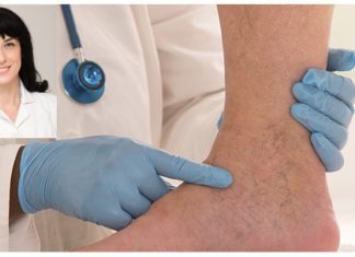 Dr. Liljana Brajeviq: Faktorët e rrezikut, simptomat dhe zgjidhjet për venat e zgjeruara