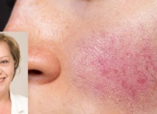 Prim. Dr. Lidija Biserkoska-Atanasovska: Çfarë nënkupton kur në lëkurë shfaqen akne dhe skuqje, ndërsa puberteti ka kaluar