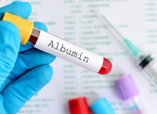 HULUMTIM: Niveli i ulët i albuminës mund të parashikojë rezultate më të këqija te pacientët me COVID-19