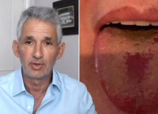 GJITHNJË E MË SHUMË TË INFEKTUAR ME KORONAVIRUS SHFAQEN ME KËTË SIMPTOMË: Çfarë do të thotë të kesh “COVID gjuhën”?