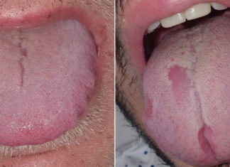 SIMPTOMA E RE E COVID-19: Cilat ndryshime të gjuhës mund të tregojnë se jeni të infektuar