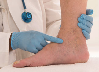 Si formohen mpiksjet e gjakut – trombet dhe si trajtohet tromboza