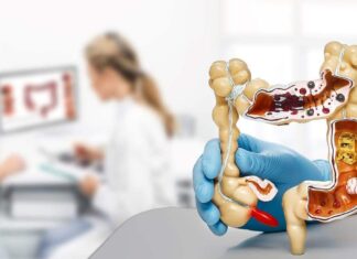 ILAÇI I RI KUNDËR KANCERIT PO BËN HISTORINË: Kanceri i rektumit është larguar tek të gjithë pacientët në hulumtim