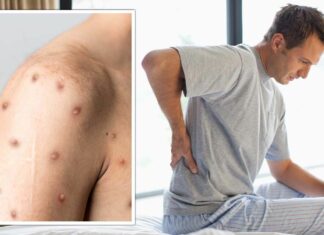 8 simptomat e lijes së majmunëve ndaj të cilave duhet të bëni kujdes