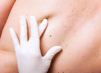 DERMATOLOGËT PARALAJMËROJNË SIMPTOMAT E KANCERIT TË LËKURËS QË SHUMË NJERËZ I INJOROJNË: Si të dalloni një nishan të dyshimtë