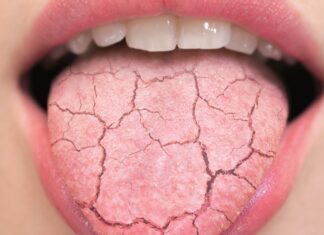 KSEROSTOMIA: Shfaqja e kësaj simptome të hershme mund të tregojë infeksionin me koronavirus