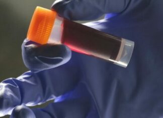 HULUMTUESIT ZBULOJNË CILA: Grupë e gjakut mund të ndikojë në rrezikun e sulmit në tru